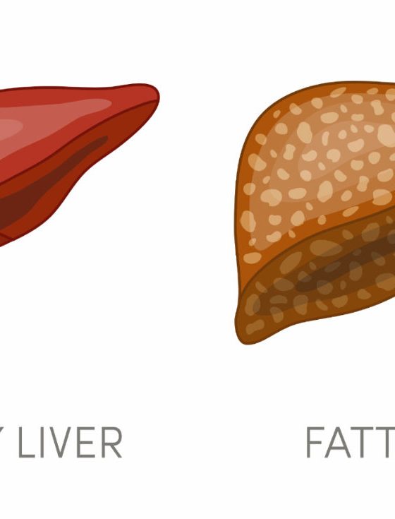 The Connection between Obesity and Fatty Liver
