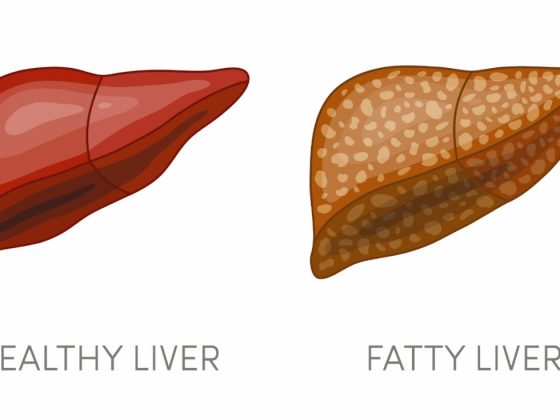 The Connection between Obesity and Fatty Liver