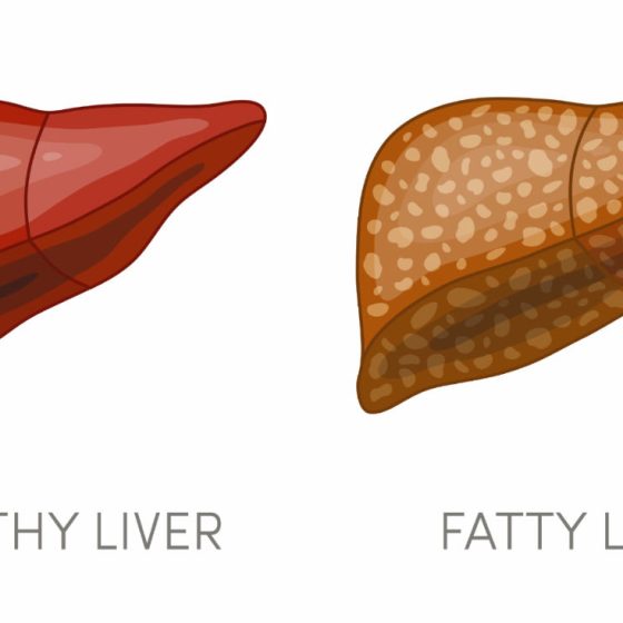 The Connection between Obesity and Fatty Liver