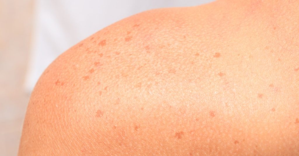 Show off Impeccable Skin with the Intense Pulsed Light (IPL) Procedure!