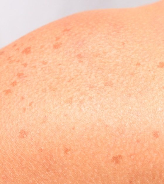 Show off Impeccable Skin with the Intense Pulsed Light (IPL) Procedure!