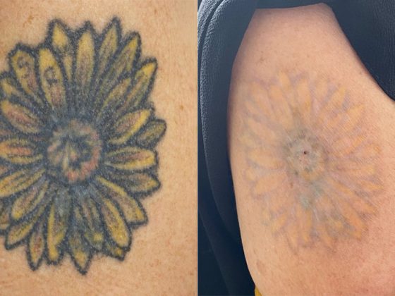 Answering Frequently Asked Questions about Laser Tattoo Removal