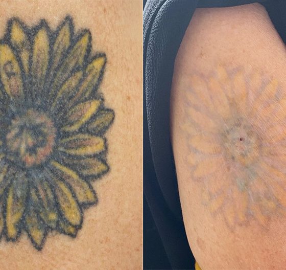 Answering Frequently Asked Questions about Laser Tattoo Removal