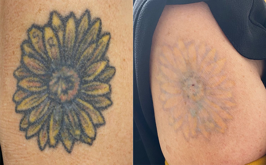 Answering Frequently Asked Questions about Laser Tattoo Removal