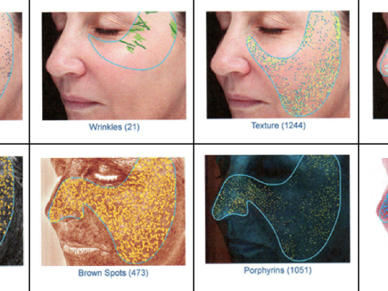 Visia Skin Analysis: Personalized Skin Care Treatment at Its Finest